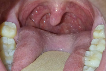 Tonsils……when to worry?