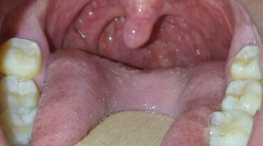 Tonsils……when to worry?