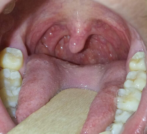 Tonsils……when to worry?