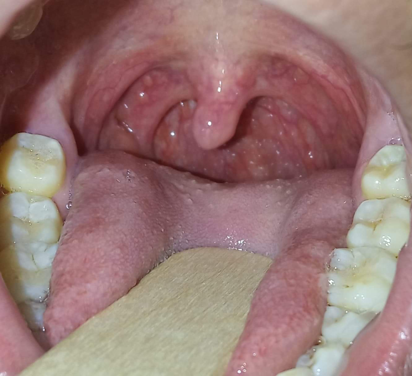 What Do White Spots On My Tonsils Mean